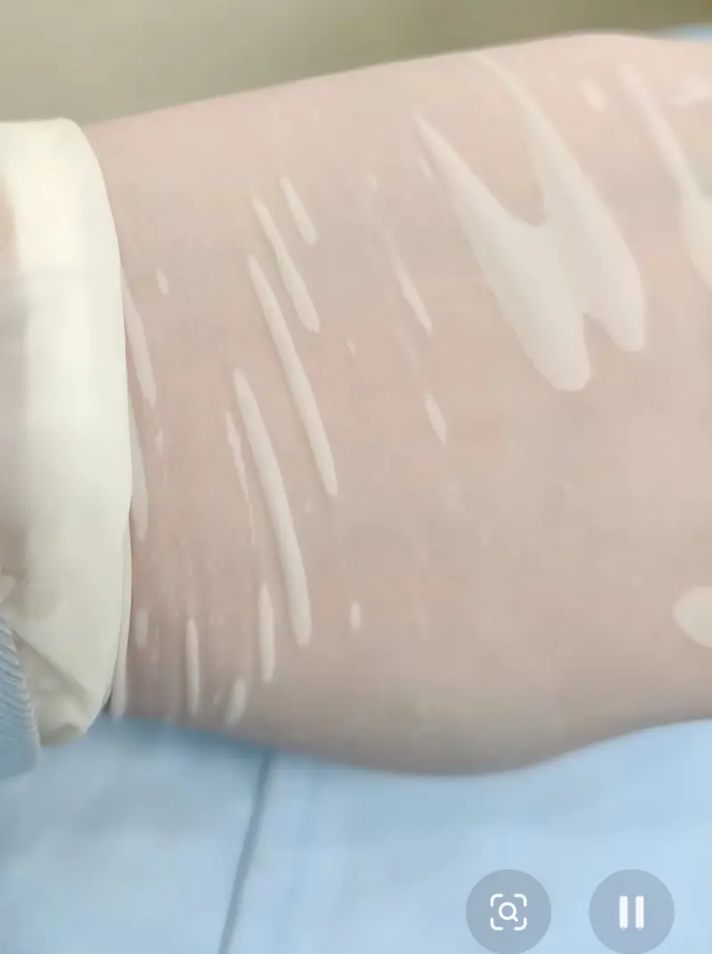 Sweat buildup inside cleanroom latex gloves